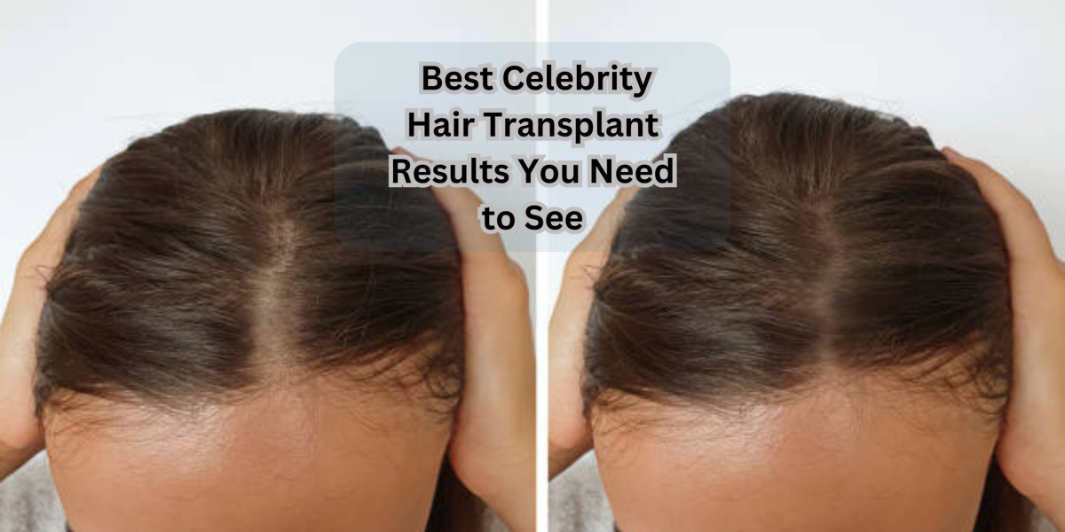 Best celebrity hair transplant Results You Need to See